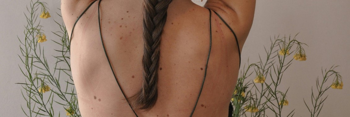 Skin tags